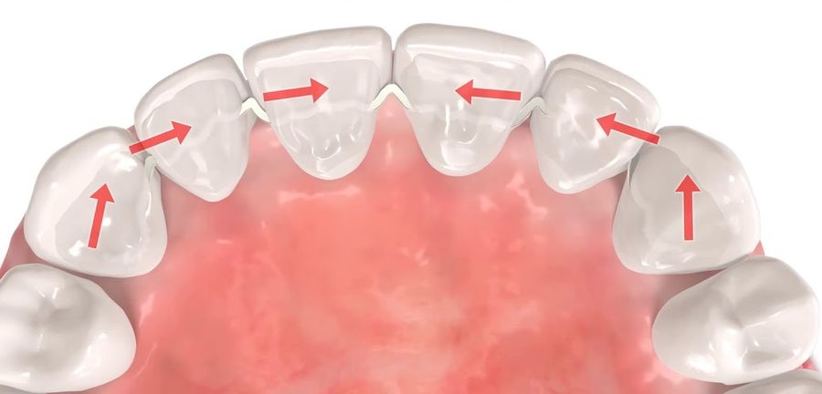 Illustration : déplacement des dents par gouttière
