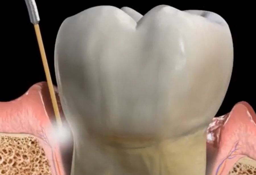 Illustration : laser en parodontologie